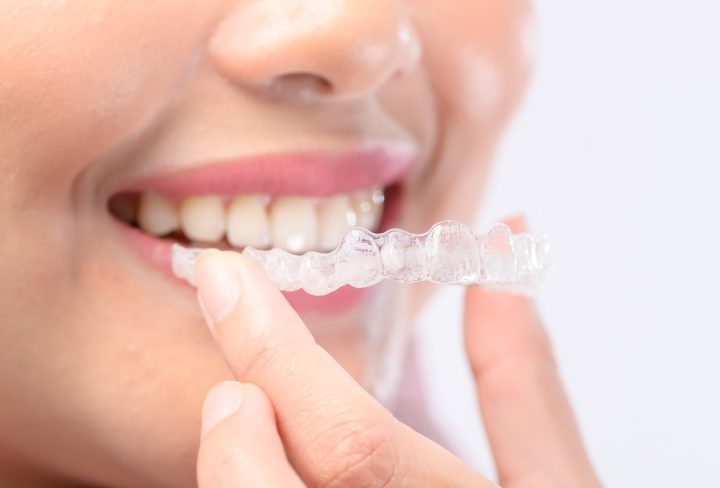 Aligners