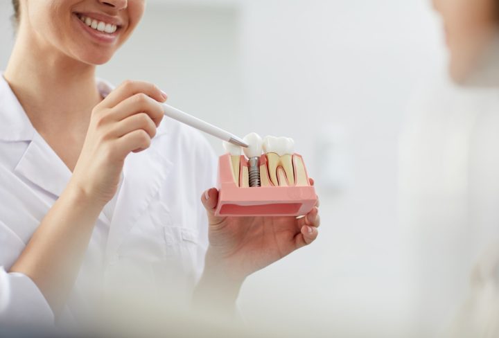 Dental Implants